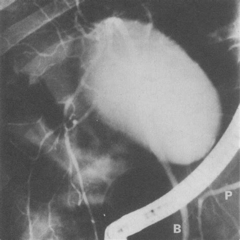 Ercp Showing The Pancreatic Duct P The Common Bile Duct B