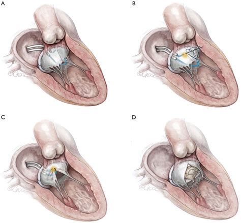 Lampoon Techniques To Prevent Or Manage Left Ventricular Outflow Tract