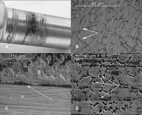 Corrosion Of A Hip Stem With A Modular Neck Taper Junction The