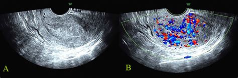 Uterine Cancer Ultrasound Images