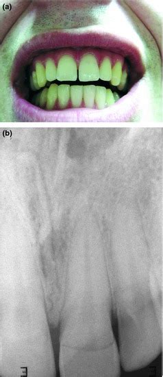 Preoperative View Of Fractured Tooth B Radiograph Of Fractured Tooth