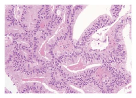 Examples Of Ductal Adenocarcinoma Of The Prostate A Stain Of Ductal Download Scientific