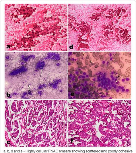 Figure From Multiple Remote Cutaneous Metastases From Male Breast