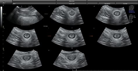 Transperineal Ultrasound Transperineal Ultrasound Of The Anal Download Scientific Diagram