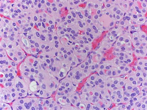 Pathology Outlines Poorly Differentiated Thyroid Carcinoma