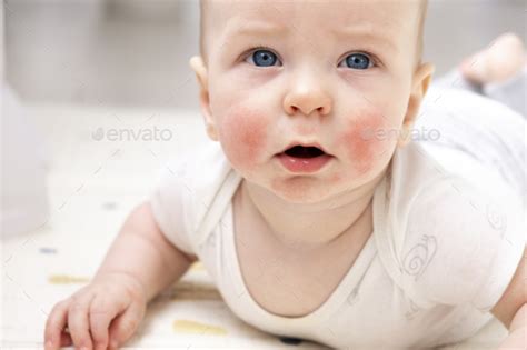 Baby Face With Eczema On Cheeks Atopic Dermatitis Stock Photo By Ta Bu