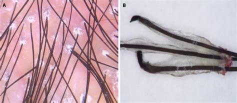 Extraction of Fairly Normal Appearing Anagen Hairs Signifies Active ...