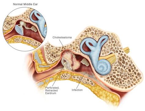 Cholesteatoma In Its Simplest Definition Is Skin In The Wrong Place