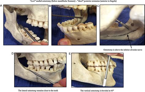 Use Of A ‘low And Short Medial Cut Limits Sagittal Ramus Osteotomy