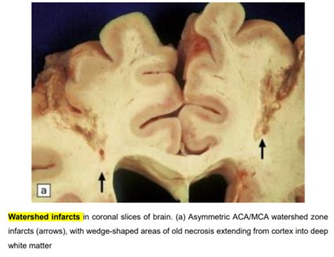 Strokes Intercranial Hemorrhages Brain Herniation Spinal Cord