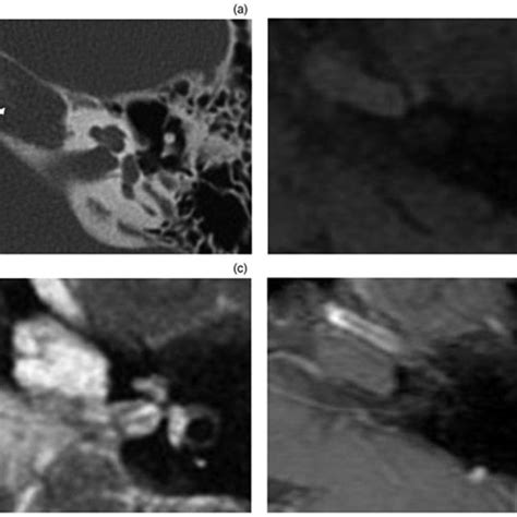 Radiological imaging of petrous apicitis (right ear). (a) Axial ...