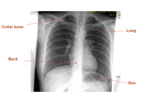 Plain Radiograph X Ray Insideradiology