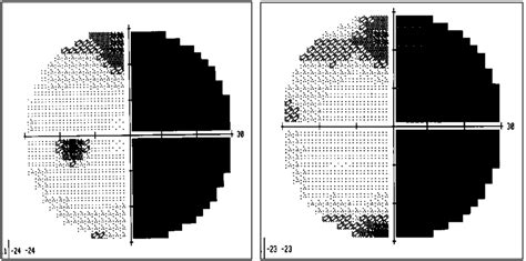 Type Of Homonymous Visual Field Loss Not A Predictor Of Driver Safety