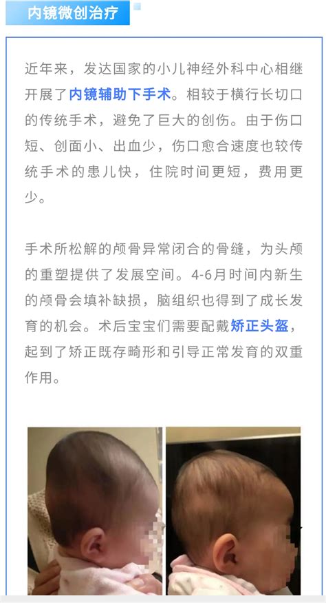 警惕婴儿颅骨畸形：关注宝宝的“头”等大事，不可怠慢！ 微医（挂号网）