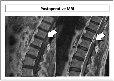 Postoperative Mri Assessment Showing Complete Resection In The Absence