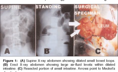 Figure 1 From Inverted Meckels Diverticulum Causing Intussusception In An Adult Semantic Scholar