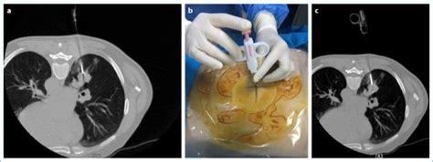 Computed Tomography Guided Transthoracic Core Needle Biopsy Of Lung