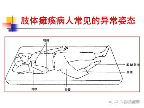 脑梗死及肢体功能位 知乎