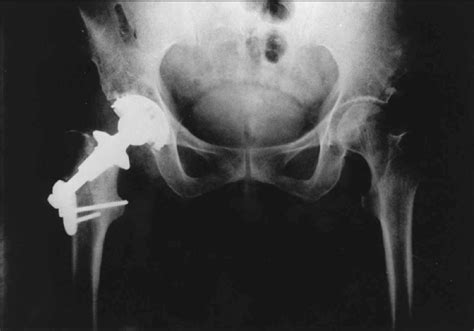 Thrust Plate Prosthesis Download Scientific Diagram