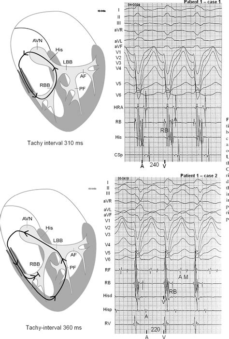 Figure 1 From The Atrioventricular Interval During Pre Excited