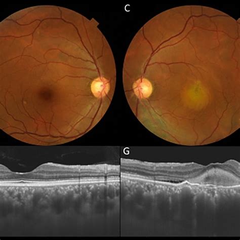 A Year Old Male Patient With Central Serous Chorioretinopathy And