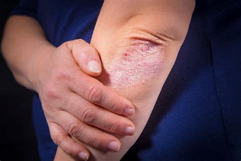 Dealing with Eczema? Dupixent May Be the Solution You’ve Been Searching
