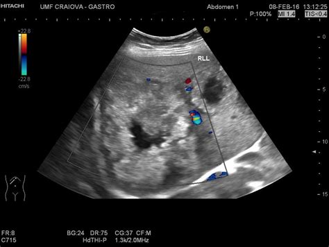 Liver Metastases [3 Images] Efsumb