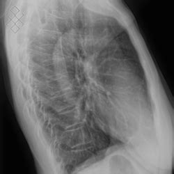 Radiographie Thoracique Définition Déroulement Prise de rdv en ligne