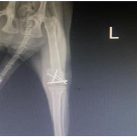 Case 11 Postoperative A P Radiography Of Supracondylar Y Fracture