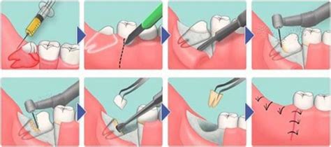 Extracción De La Raíz De Un Diente Con Caries Y Caries Es Doloroso Extraerlo Cómo Eliminarlo