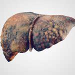 Can The Liver Heal Itself Fatty Liver Disease