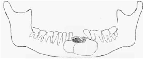 Schematic Diagram Of Pattern Of Ameloblastoma In The Anterior Mandible Download Scientific