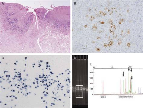 Expression Of Epstein Barr Virus Ebv Markers In Ebv Positive