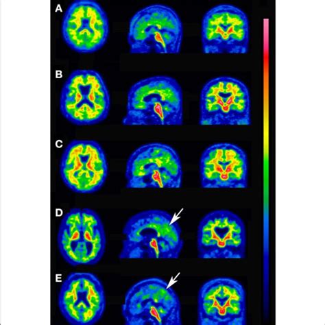 Concordant Cases Between Quantitative Assessments And Visual