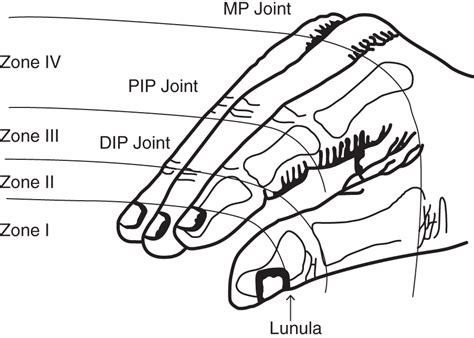 Replantation Musculoskeletal Key