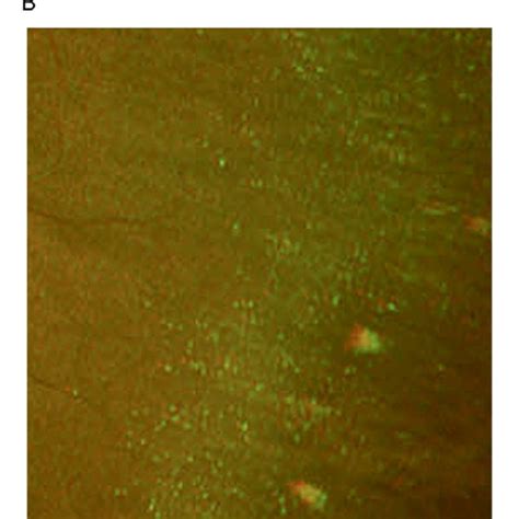 Wide-field fundus autofluorescence of ora serrata pearls (OSPs) from ...