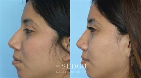 Crooked Nose Surgery Before After Photos Dr Sedgh