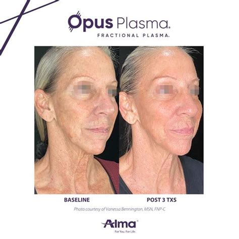 Opus Plasma Skin Tightening Gallery The Beauty Spot In Boulder Colorado