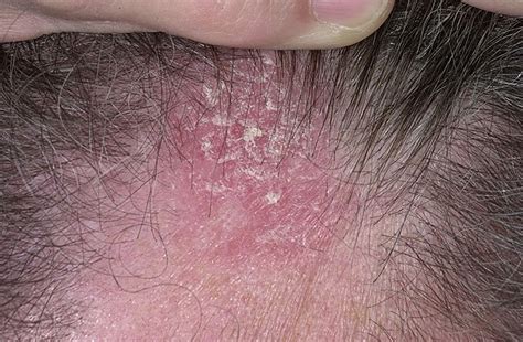 adult eczema - pictures, photos