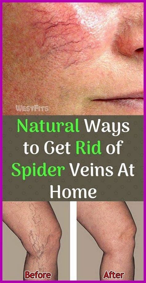 Natural Methods To Get Rid Of Spider Veins Facial Spider Veins Get Rid