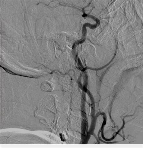 Lateral Digital Subtraction Angiography Of The Right Common Carotid