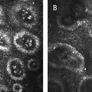 Meibomianitis. (A and B) Meibomian glands with meibomianitis, with high ...