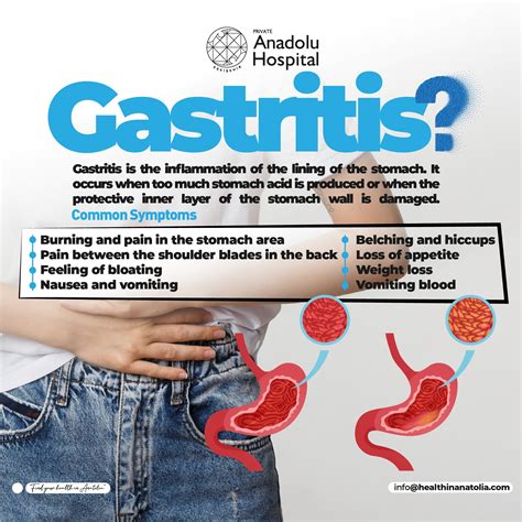 Health - Gastritis is the inflammation of the lining of the stomach. It