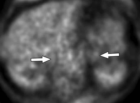 Petct For The Characterization Of Adrenal Masses In Patients With