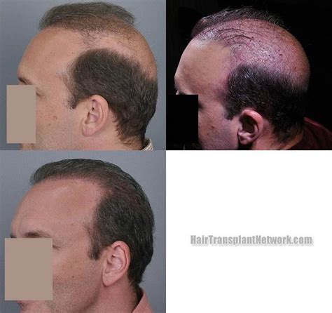 Dr Jerry Cooley Hair Restoration Surgery Before And After Result Images With 4000 Grafts