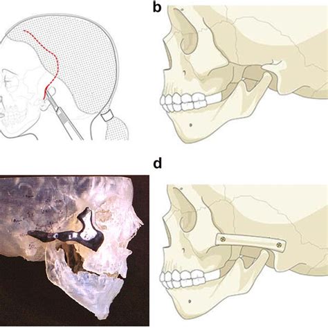 Planning For Construction Of Missing Zygomatic Bone Glenoid Fossa And Download Scientific