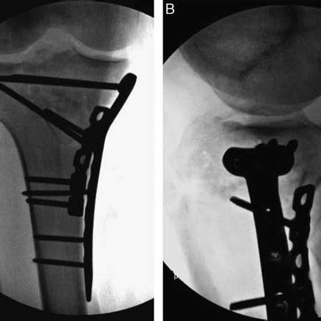 Anterioposterior A And Lateral B Intraoperative Fluoroscopic Views