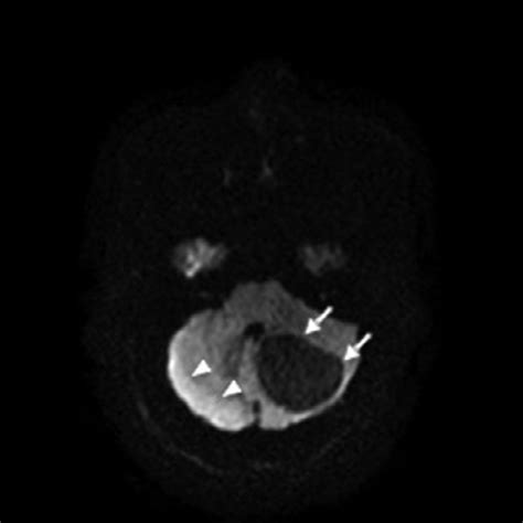 Diffusion Weighted Axial Images Of A Brain Mri The Left Cerebellar