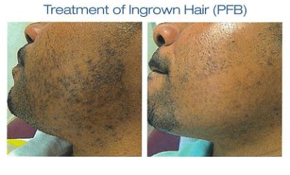 Razor Bumps/Ingrown Hair in Brooklyn, NY | Dr. Ghatan Dermatology ...