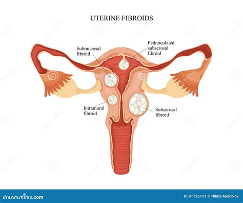 Uterine Fibroid Stock Vector Illustration Of Problem 81726111